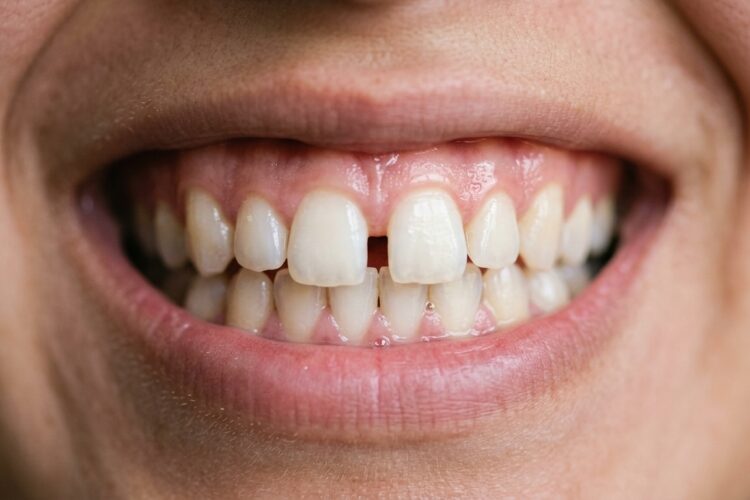 Sonrisa con espacio entre los dientes de adelante antes de un tratamiento de diastema en Vanedent, Breña